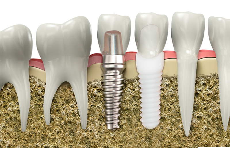 Phục hình răng sứ Implant: Sự hòa hợp giữa thẩm mỹ và chức năng